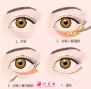 手術(shù)祛除眼袋會(huì)不會(huì)失敗？