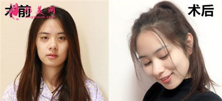 上海玫瑰醫(yī)療美容醫(yī)院的眼部多項(xiàng)整形的案例