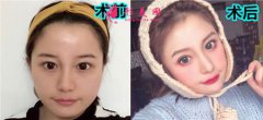 杭州麗脂醫(yī)療美容醫(yī)院的面部吸脂效果怎么樣？真人案例分享
