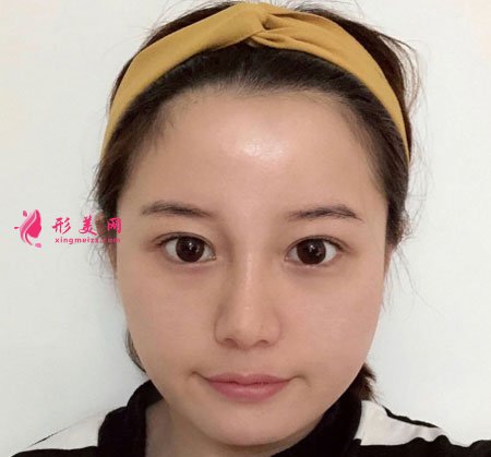 杭州麗脂醫(yī)療美容醫(yī)院的面部吸脂案例