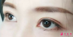 雙眼皮整形后會不會有后遺癥？