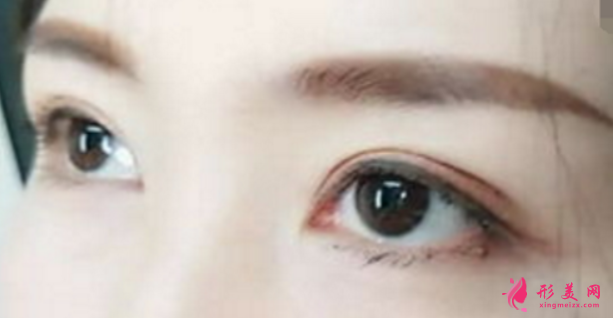 雙眼皮整形后會不會有后遺癥