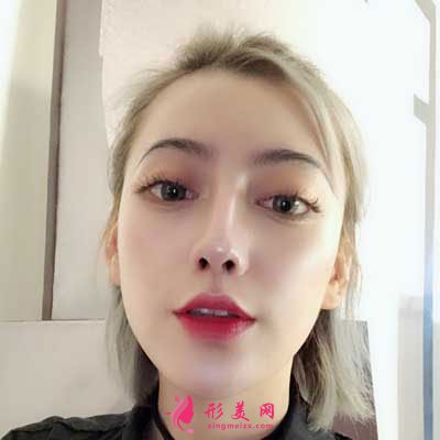 成都軍大整形鼻綜合整形成功案例