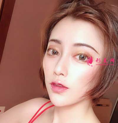 成都軍大整形鼻綜合整形成功案例