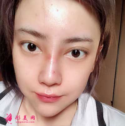 成都軍大整形鼻綜合整形成功案例
