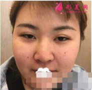 北京八大處整形做的面部吸脂怎么樣？術后顏值直線上升！
