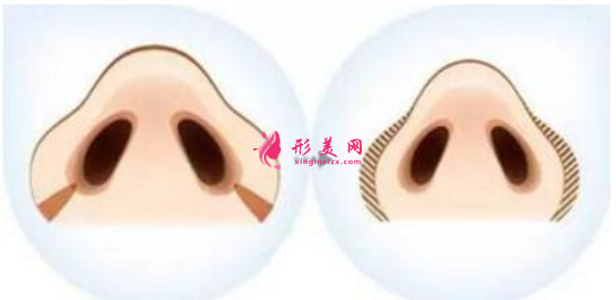 鼻翼縮小手術(shù)容易出現(xiàn)的后遺癥