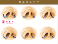 鼻翼縮小手術(shù)容易出現(xiàn)的后遺癥？