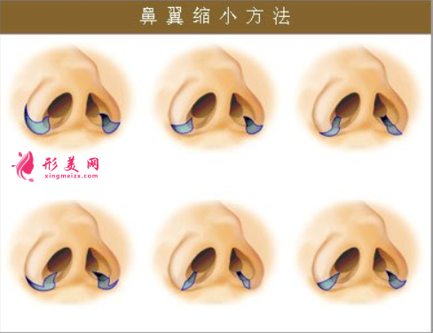 鼻翼縮小手術(shù)容易出現(xiàn)的后遺癥