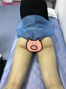 腿部吸脂案例分享|煩人的大象腿終于變細(xì)了