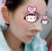 隆鼻的真實(shí)案例前后對(duì)比圖：恢復(fù)7-30天效果記錄！