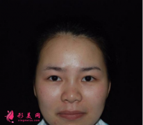 北京葉子整形魯禮新做的雙眼皮 術(shù)后60天效果對比真的很不錯
