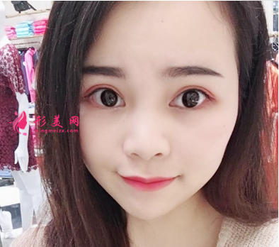 找北京葉子整形魯禮新做的雙眼皮 術(shù)后60天效果對比真的很不錯(cuò)