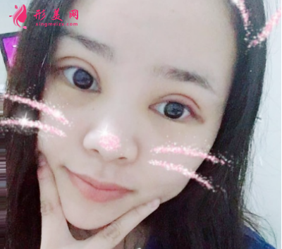 找北京葉子整形魯禮新做的雙眼皮 術(shù)后60天效果對比真的很不錯(cuò)