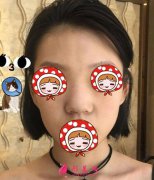 上海華美剛做完隆鼻真實(shí)案例，迫不及待的想給大家分享