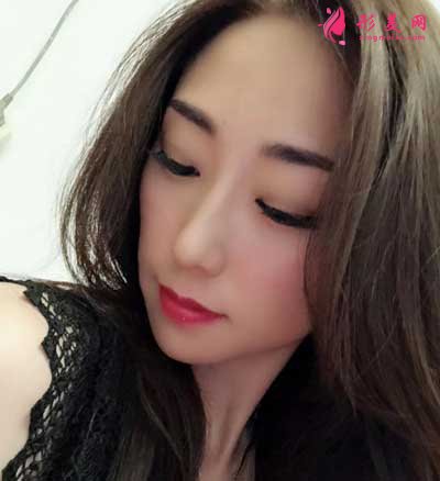 在和顏美帕找劉喆做的白瓷娃娃項(xiàng)目 術(shù)后30天效果圖分享