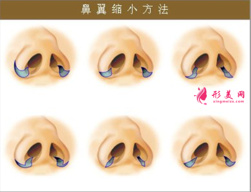 做鼻翼縮小的效果如何