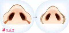 鼻翼縮小手術(shù)恢復(fù)期內(nèi)要怎么護(hù)理？