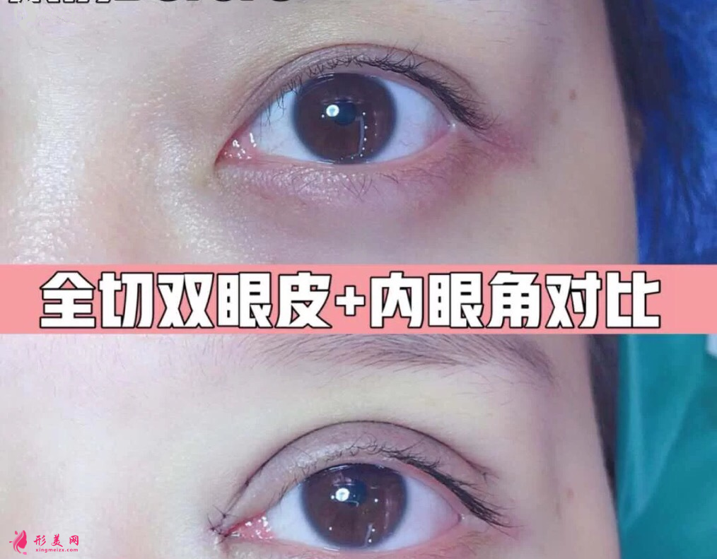 北京克萊美舍張冰潔眼綜合案例 北京克萊美舍張冰潔眼綜合案例