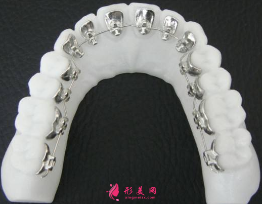 舌側(cè)內(nèi)矯正牙齒到底好不好