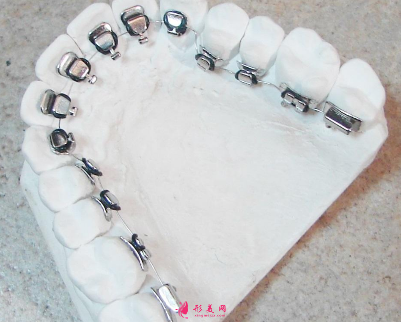 舌側(cè)內(nèi)矯正牙齒到底好不好