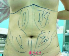 成都玉之光腰部吸脂案例，術(shù)后恢復(fù)記錄分享~