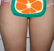 上海玫瑰鄒功偉做的大腿吸脂，術后85天效果對比真的非常不錯