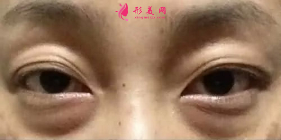 什么是眼袋？祛眼袋有哪些優(yōu)勢呢？