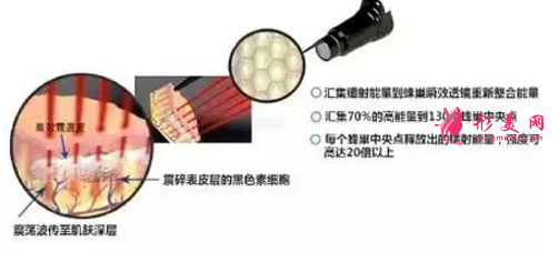 什么是皮秒祛斑？與其他有何對比？