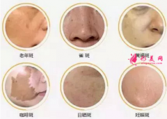 什么是皮秒祛斑？與其他有何對比？