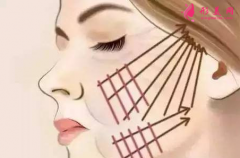 什么是面部線雕提升術(shù)？有副作用嗎？能維持多久？