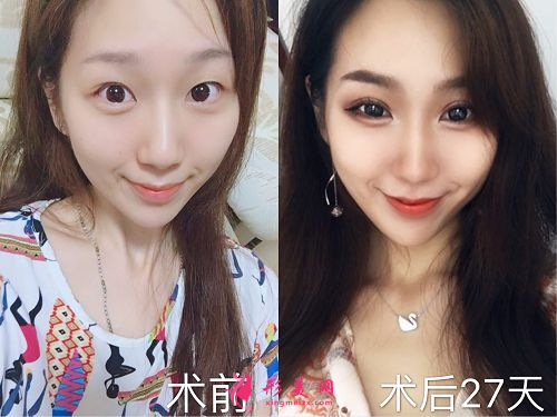 深圳非凡整形郭羨做雙眼皮怎么樣？收費標(biāo)準？案例分享