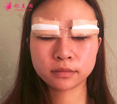 溫州和平整形醫(yī)院雙眼皮手術(shù)案例