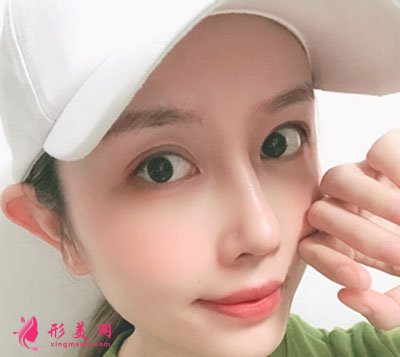 成都菲格隆鼻手術案例