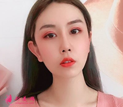 成都菲格隆鼻手術案例