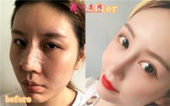 成都菲格醫(yī)療美容醫(yī)院廖小川隆鼻怎么樣？真人案例分享