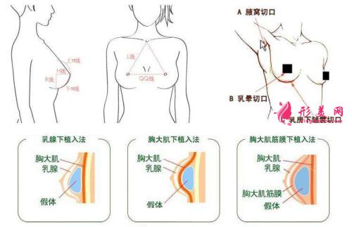 硅膠隆胸手術疼嗎？疼痛時間維持多久？