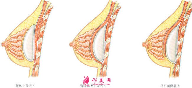硅膠隆胸手術疼嗎？疼痛時間維持多久？
