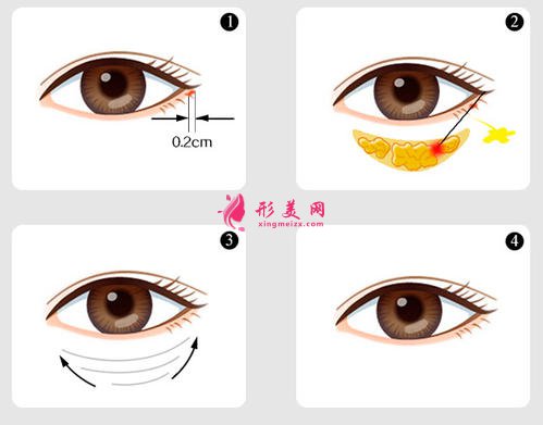 溶脂去眼袋價格是多少錢？適合多大年齡的人？