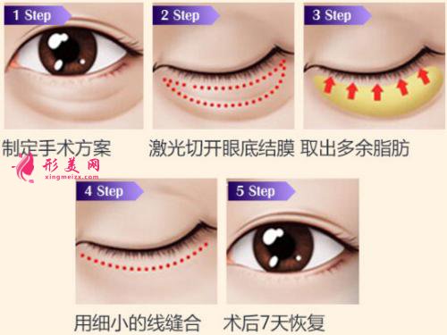 溶脂去眼袋價格是多少錢？適合多大年齡的人？