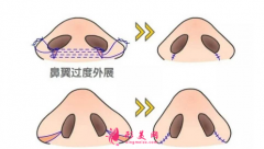 解讀鼻尖縮小整形手術(shù)，術(shù)后注意事項(xiàng)大全~