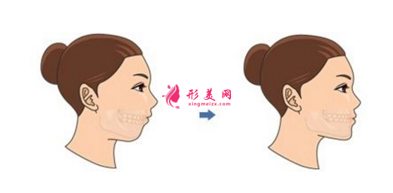 磨下巴整形風(fēng)險(xiǎn)有多大？該如何避免？