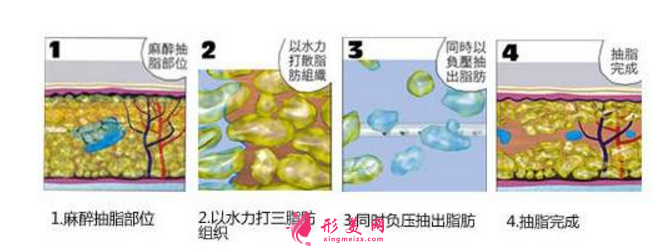 上臂吸脂后臂腫脹怎么辦？術(shù)后護理要牢記！