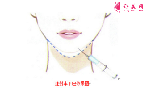 自體脂肪豐下巴和玻尿酸豐下巴哪個(gè)好