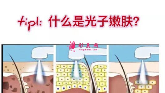 【美麗加分】面部光子嫩膚能帶來哪些效果？