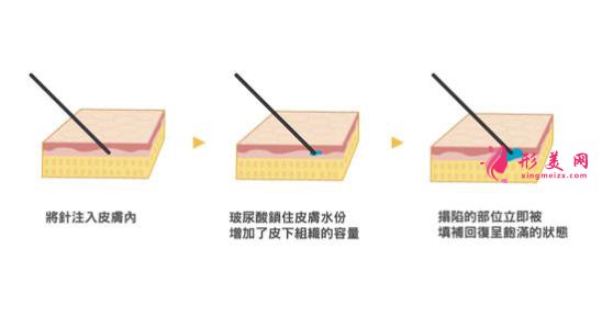 打玻尿酸要多少錢
