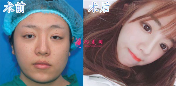 北京百達(dá)麗眼部修復(fù)案例
