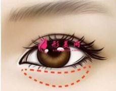 手術(shù)祛眼袋有疤怎么辦？