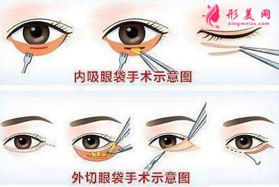 手術(shù)祛眼袋有疤怎么辦