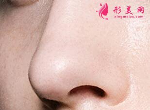 廣州假體隆鼻手術(shù)要多少錢
